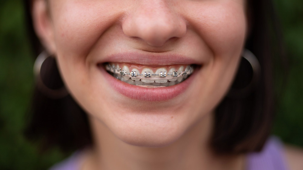 The Benefits of Dental Braces