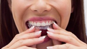 Read more about the article Invisible Braces Procedure: Duration, Steps, and Aftercare