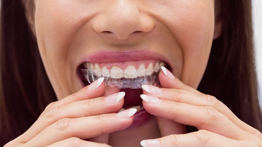 Invisible Braces Procedure: Duration, Steps, and Aftercare